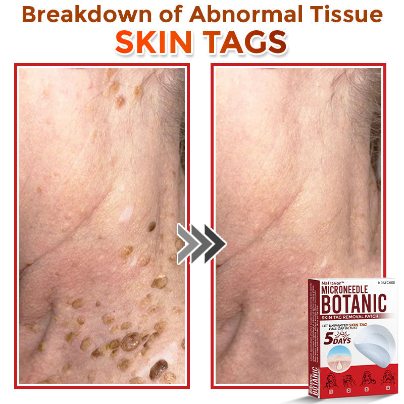 Natravor® MicroNeedle Botanic Skin Tag Removal Patch ✅Australian Made