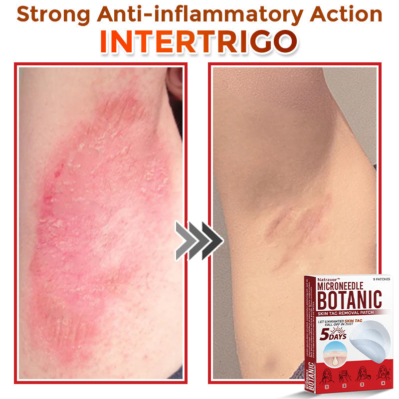 Natravor® MicroNeedle Botanic Skin Tag Removal Patch ✅Australian Made