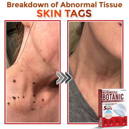 Natravor® MicroNeedle Botanic Skin Tag Removal Patch ✅Australian Made