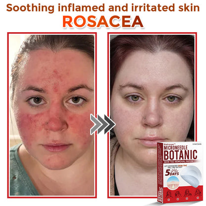 Natravor® MicroNeedle Botanic Skin Tag Removal Patch ✅Australian Made