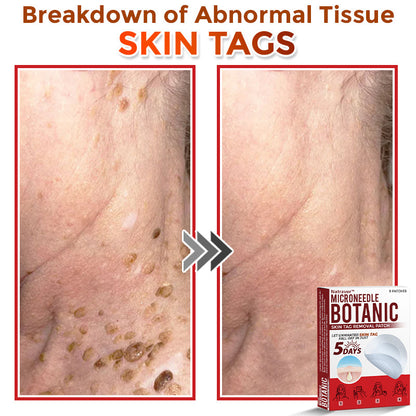 Natravor® MicroNeedle Botanic Skin Tag Removal Patch ✅Australian Made
