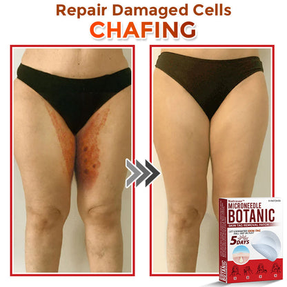 Natravor® MicroNeedle Botanic Skin Tag Removal Patch ✅Australian Made
