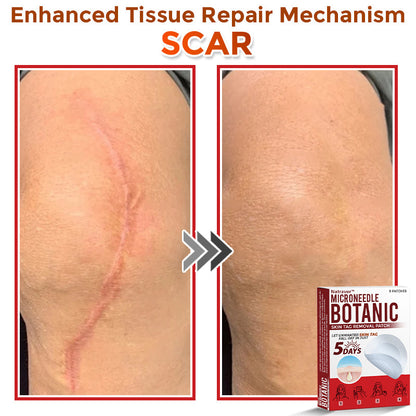 Natravor® MicroNeedle Botanic Skin Tag Removal Patch ✅Australian Made